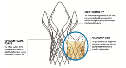 image 1 of Hydra TAVI Bio-prosthesis designed & developed by vascular innovations