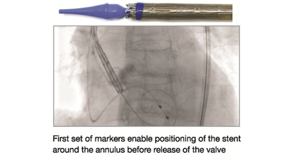 image 2 of Hydra TAVI Bio-prosthesis designed & developed by vascular innovations