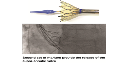 image 4 of Hydra TAVI Bio-prosthesis designed & developed by vascular innovations