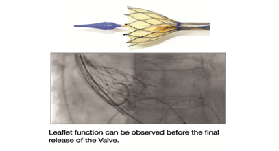 image 3 of Hydra TAVI Bio-prosthesis designed & developed by vascular innovations