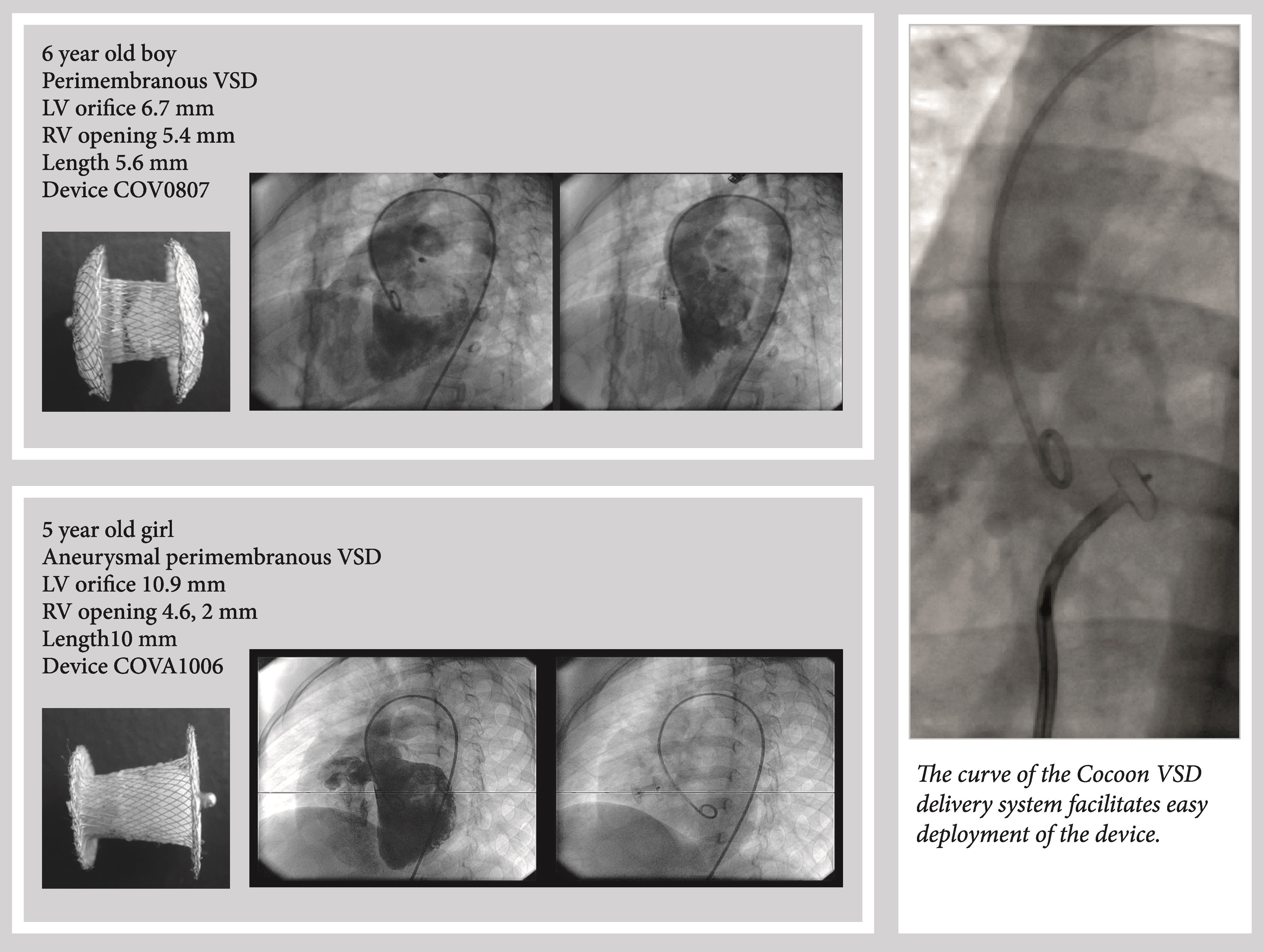 banner of Cocoon Ventricular Septal Occluder